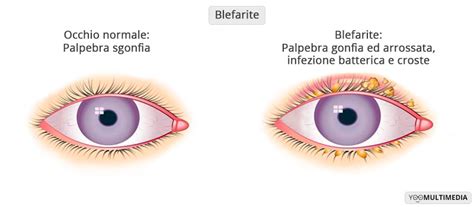 Blefarite Cause Sintomi E Cure Centro Oculistico Poliambulanza