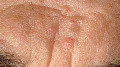 Sebaceous Hyperplasia Symptoms Causes And Treatment Sebaceous