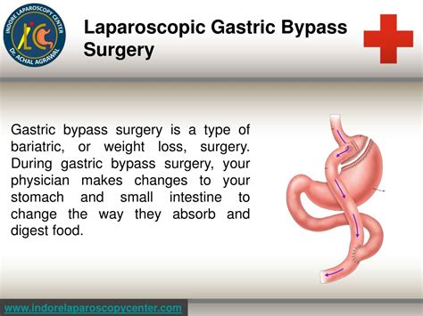 Ppt Best Laser Gastro Surgeon Dr Achal Agarwal Indore Laparoscopy Center Powerpoint