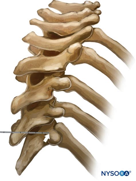 Thoracic And Lumbar Paravertebral Block Landmarks And Nerve