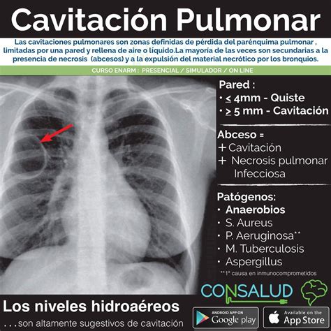 Cavitaciones Pulmonares Pdf