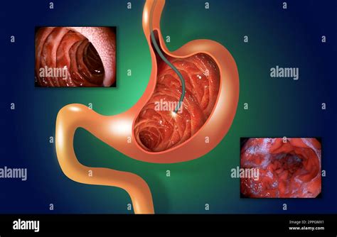 Digestive Endoscopy Or Gastroscopy Performing A Gastroscopy Procedure