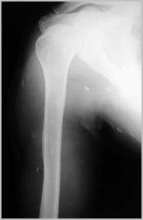 Soft Tissue Calcifications