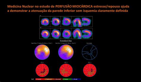 Cl Nica N Clear Mogi Cintilografia Do Mioc Rdio Teste Ergom Trico