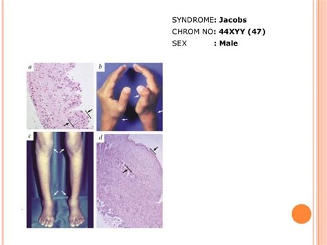 Jacob Syndrome