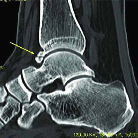 Talar Spur Yellow Arrows Causing Anterior Impingement Visible On