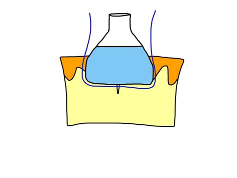 The Perfect Simple Interrupted Suture – Closing the Gap