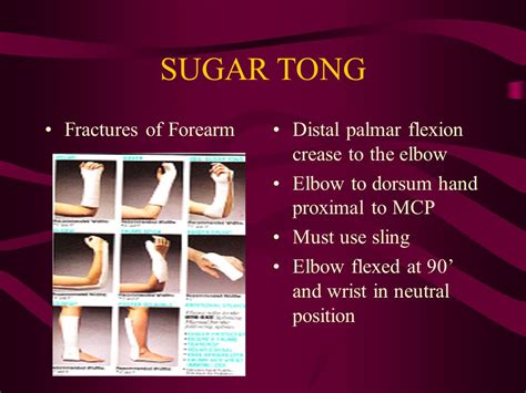 Reverse Sugar Tong Splint