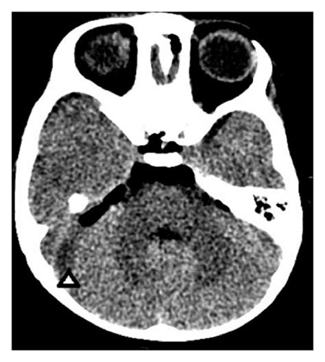 Head Ct On Day For Evaluation Of Meningitis A Axial Head Ct Shows