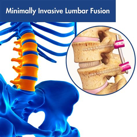 Minimally Invasive Lumbar Fusion Madison Wi