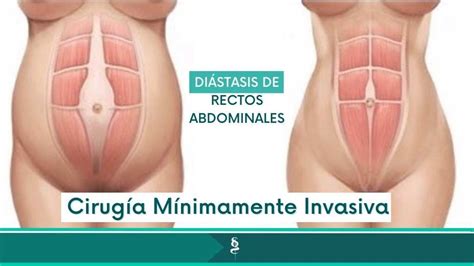 Cirug A Di Stasis Abdominal Dr Santiago G Mez Correa