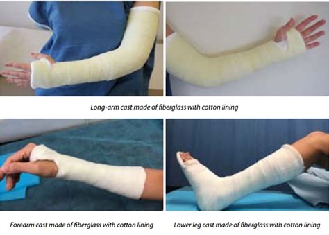 Care Of Casts And Splints Fv Magazine