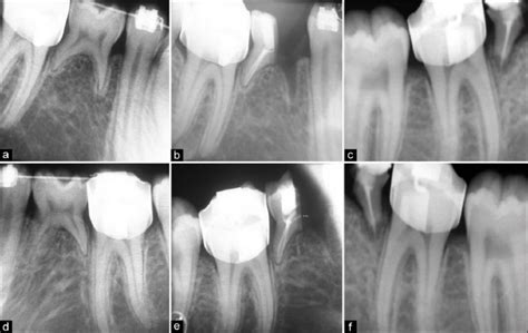 A The Iopa Radiograph Shows Preoperative Condition Of The Patient