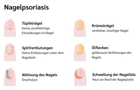 Psoriasis an den Nägeln Sorea Health