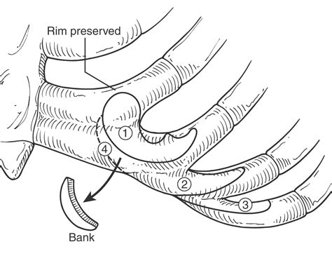 Brent Technique For Microtia Reconstruction Operative Techniques In