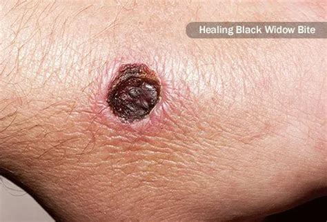 Spider Bites: How Dangerous Are They?