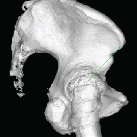 Measurement Of The Preoperative And Postoperative Distance From The