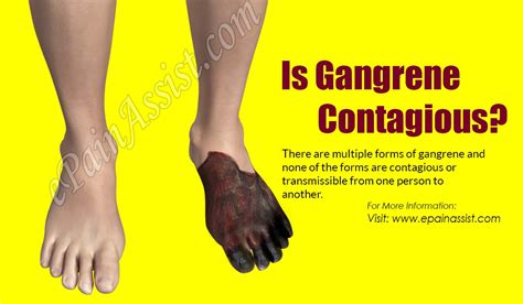 gangrene – Liberal Dictionary