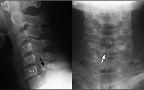 A Lateral Radiograph Of Cervical Spine Showed A Cleft Between The