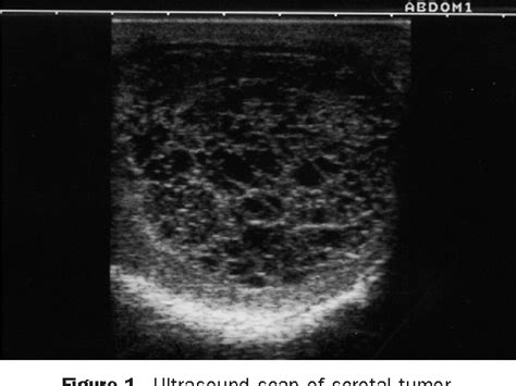 [pdf] Case Report Tuberculous Epididymitis Presenting As Huge Scrotal