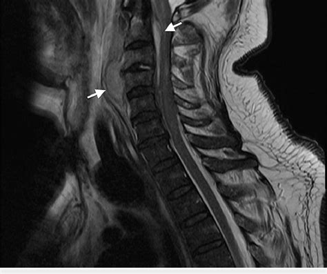 Sagittal T2 Mri Revealing An Anterior Epidural Abscess C1 C4