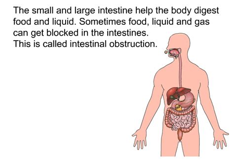 PatEdu Intestinal Obstruction