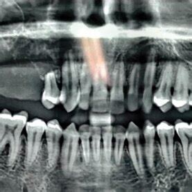 Pre Op Orthopantomograph Shows An Ill Defined Homogenous Radiolucency