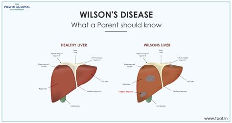 Wilson Disease