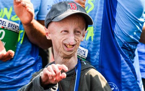 Addio A Sammy Basso Aveva 28 Anni Aveva Fatto Conoscere La Progeria