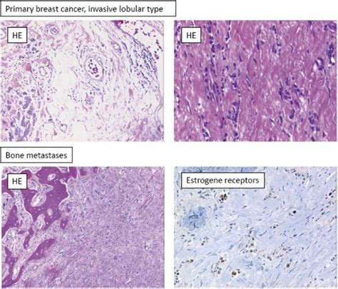 Histology Of The Primary Invasive Lobular Breast Cancer Magnification Download Scientific