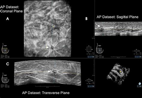 Automated Breast Ultrasound An Update Applied Radiology