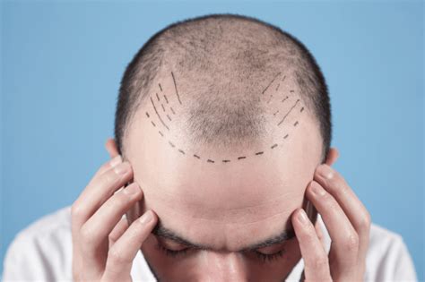 Bad Hair Transplants From Infections To Scars Revela