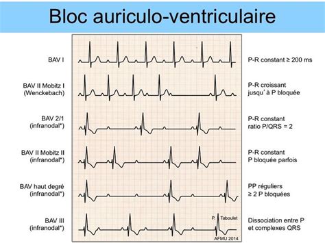 Formation à lECG de A à Z par Pierre Taboulet Taboulet Ecg et