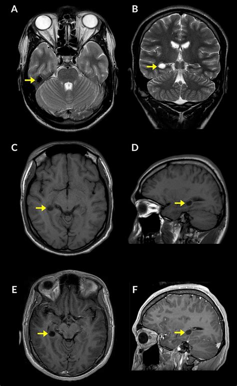 Brain Magnetic Resonance Imaging MRI Scan In A Patient With DNET