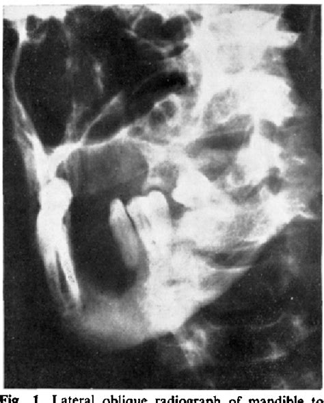 Figure 1 From Tuberculous Osteomyelitis Of The Mandible Semantic Scholar