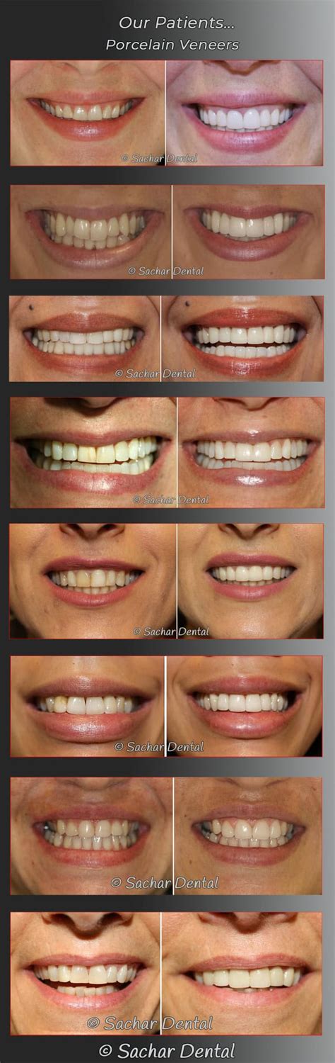 Top Nyc Dentist For Porcelain Veneers Dr Sachar