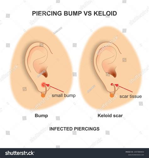 Piercing Bump Vs Keloid Illustration Ear Stock Illustration 2357880953 ...