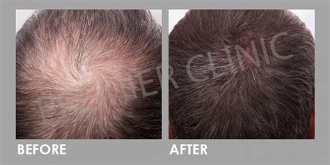 Mesotherapy For Hair Loss Premier Clinic