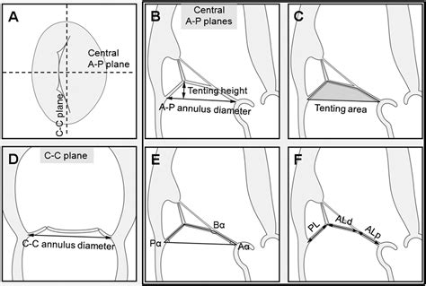 Basal Chordae Sites On The Mitral Valve Determine The Severity Of Secondary Mitral Regurgitation