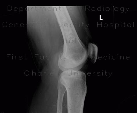 Radiology Case Bone Infarction