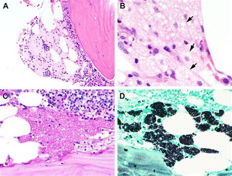 A Hematoxylin And Eosin Hande Stained Section Of The Marrow Core Biopsy