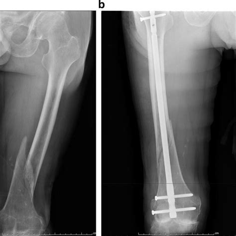 A 45-year-old patient sustained a right distal femur fracture. a ...