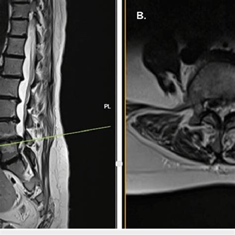 Mri Sagittal View A And Axial View B Showing A Prolapsed Disc At Download Scientific