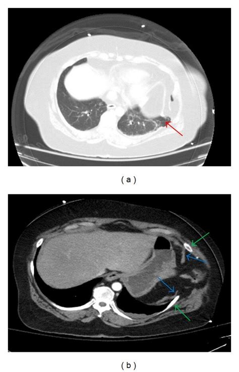 Axial Ct Images Of The Chest Demonstrate Herniation Of Lung Beyond The