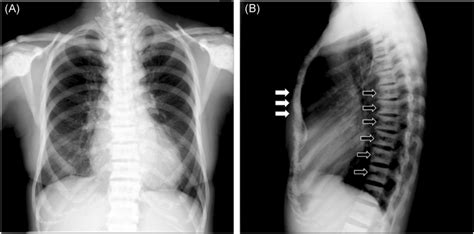 Preoperative Chest Radiography A The Posteroanterior View Showed