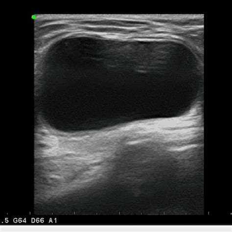 Intraoperative Picture By The Authors A Hydrocele Of The Canal Of Nuck