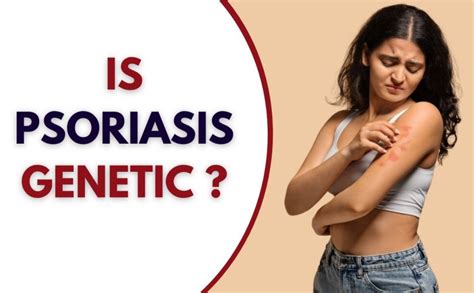 Is Psoriasis Genetic?