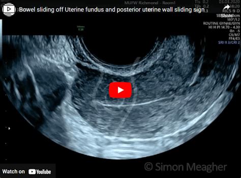 Bowel Sliding Off Uterine Fundus And Posterior Uterine Wall Sliding Sign — Melbourne