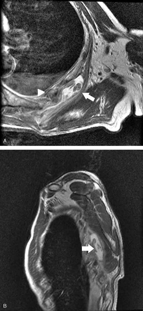 Scapulothoracic Bursitis Mri