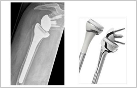 Artroplastia Do Ombro Recuperação Da Articulação